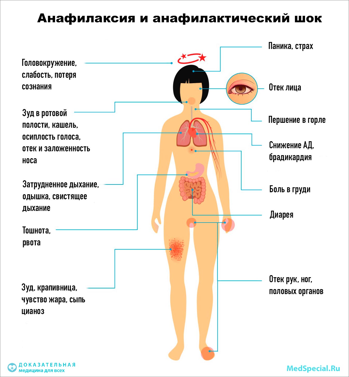 анафилаксия, анафилактический шок анафилаксия, анафилактический шок