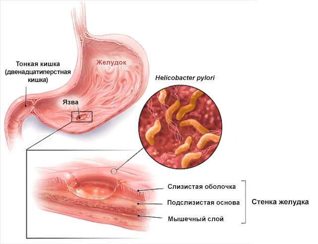 язва желудка