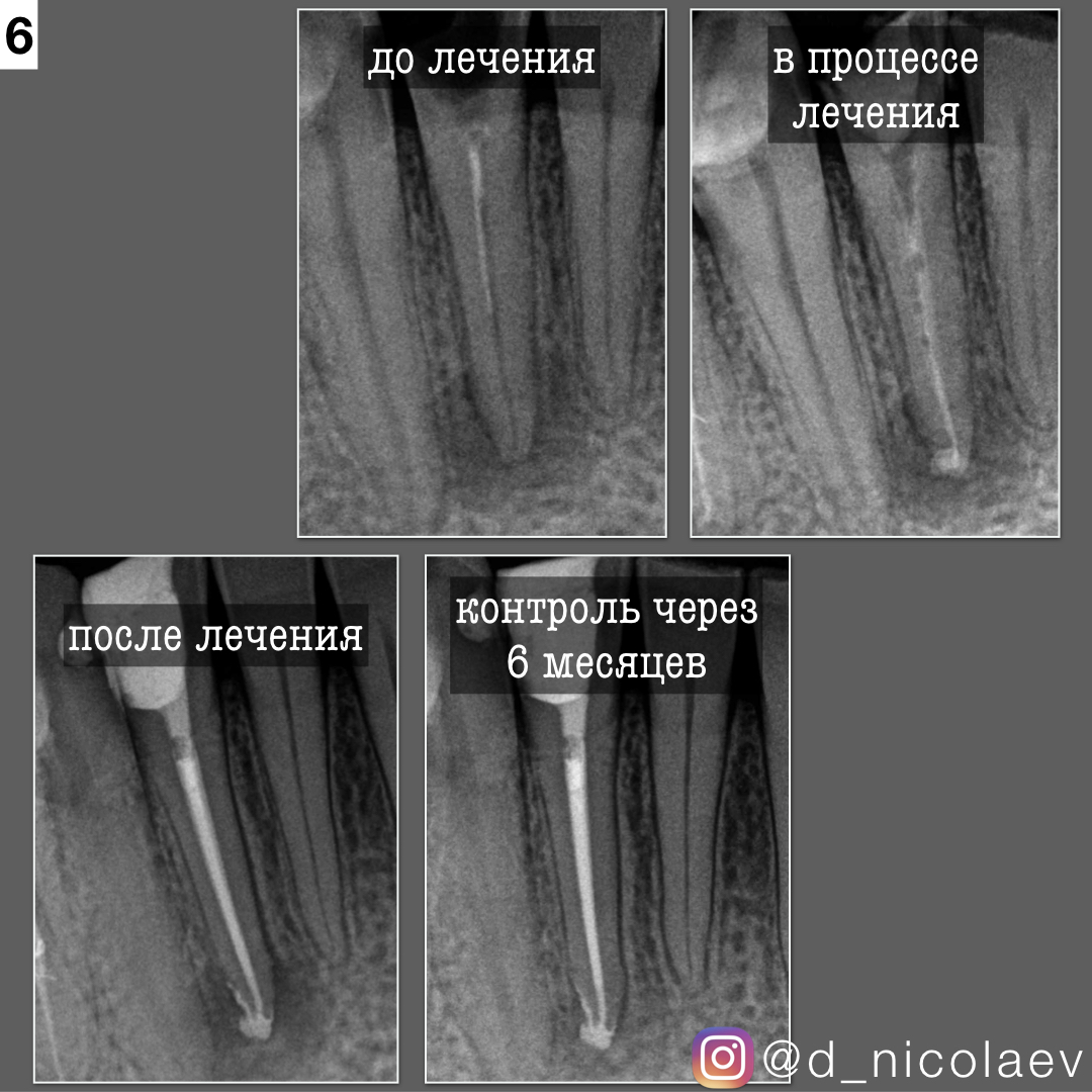 периодонтит периодонтит
