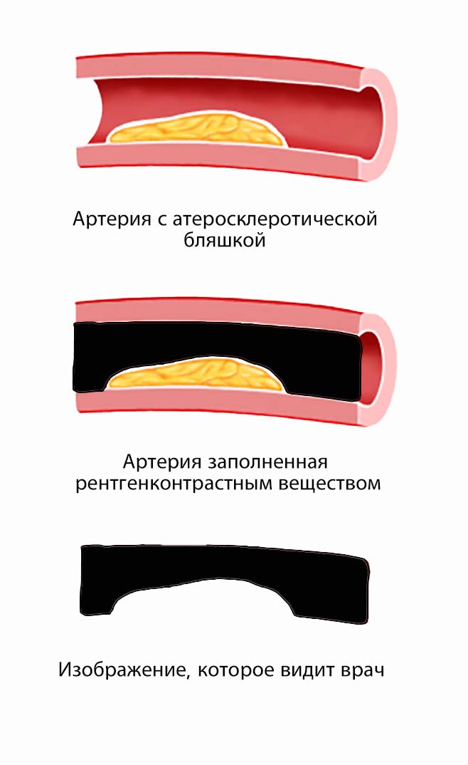 коронарография, КАГ, коронарная ангиография, ангиография сосудов сердца