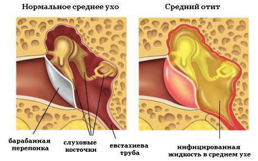 острый средний отит, средний отит, средний отит у детей, отоскопия