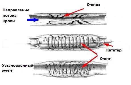 стентирование