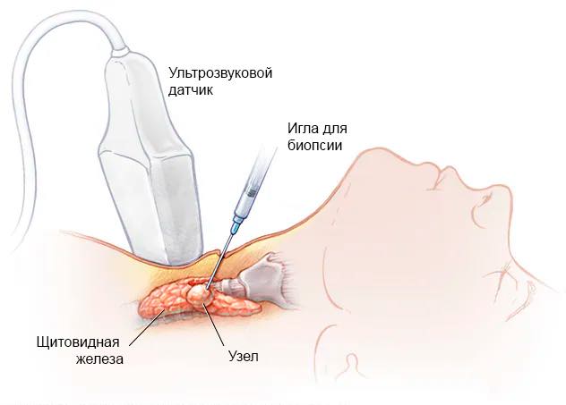 пункционная биопсия пункционная биопсия