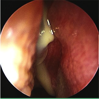 sinusitis-endo.png sinusitis-endo.png