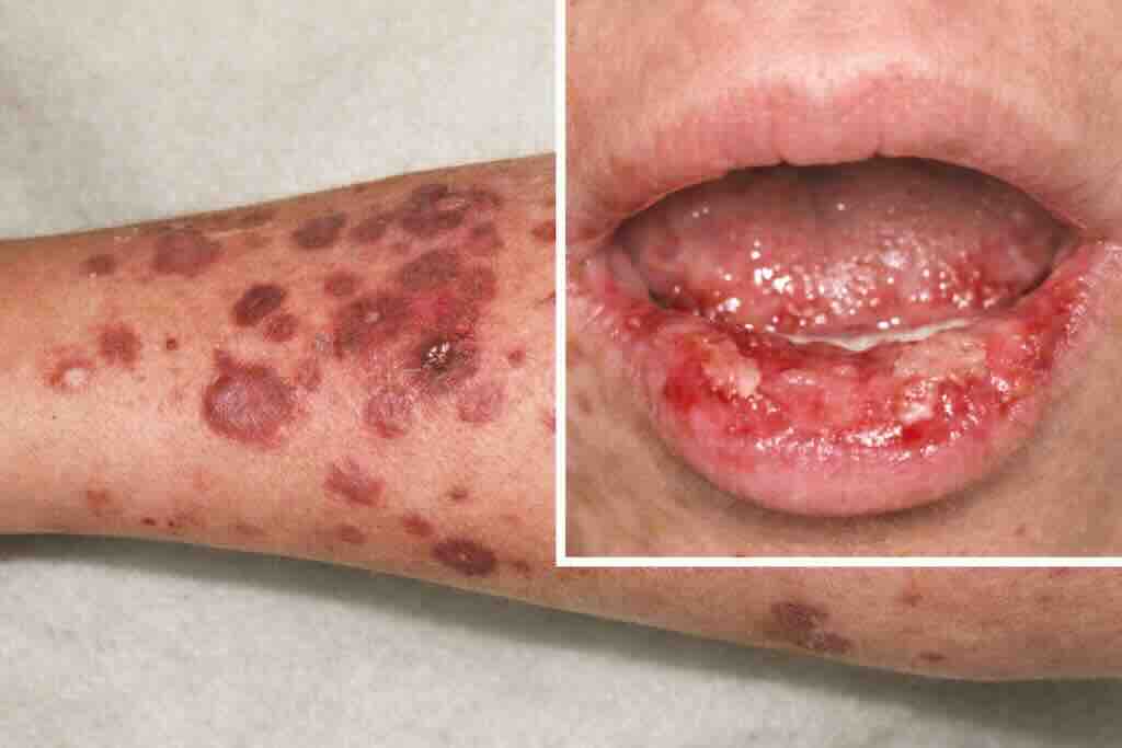 Двухпанельная иллюстрация SJS: эритематозно-пурпурные макулы/пятна на коже с тенденцией к слиянию и эрозивное поражение слизистой губ — типичный признак токсико-аллергической лекарственной реакции.