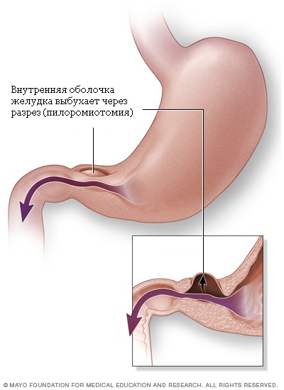 пищевод, желудок, печень, двенадцатиперстная кишка, тонкая кишка, толстая кишка, прямая кишка, пилоростеноз, пилоростеноз у детей фото пищевод, желудок, печень, двенадцатиперстная кишка, тонкая кишка, толстая кишка, прямая кишка, пилоростеноз, пилоростеноз у детей фото