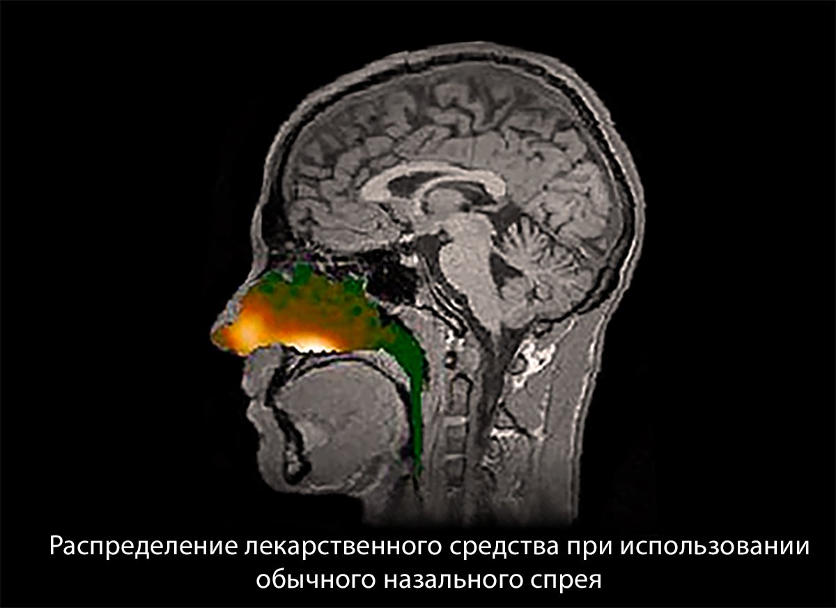 распределение лекарственных средств в полости носа при использовании обычного спрея