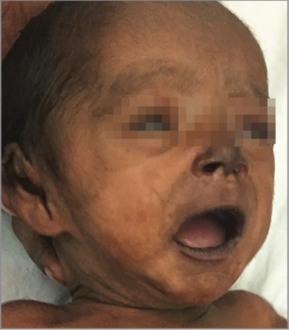 диффузная гиперпигментация, связанная с лихорадкой чикунгунья диффузная гиперпигментация, связанная с лихорадкой чикунгунья