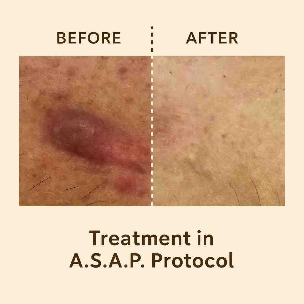 Сравнительное изображение состояния келоидного рубца до и после терапии по многоэтапному протоколу ASAP, включающему размягчение тканей, инъекции антифибротических препаратов и коррекцию пигментации.