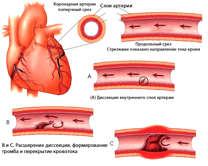 диссекция