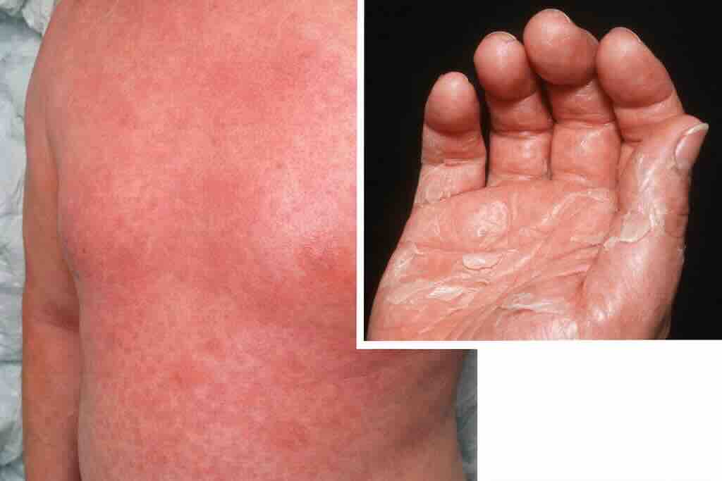 Двухпанельная иллюстрация синдрома токсического шока: ранняя диффузная эритема (“как солнечный ожог”) и поздний признак — ладонно-подошвенная десквамация через 1–2 недели. Кожные проявления оцениваются в контексте лихорадки, гипотензии и полиорганного поражения.