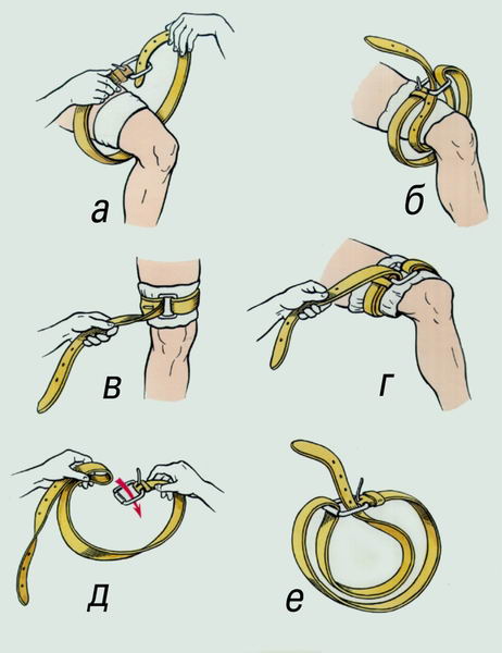 кровотечение, кровоостанавливающий жгут, наложение жгута при кровотечении, кровотечение
