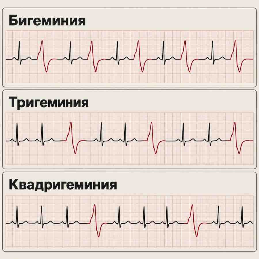 Бигеминия, тригеминия и квадригеминия при желудочковой экстрасистолии на ЭКГ