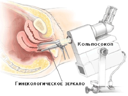 кольпоскопия