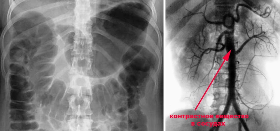 обзорная рентгенография и контрастирование сосудов