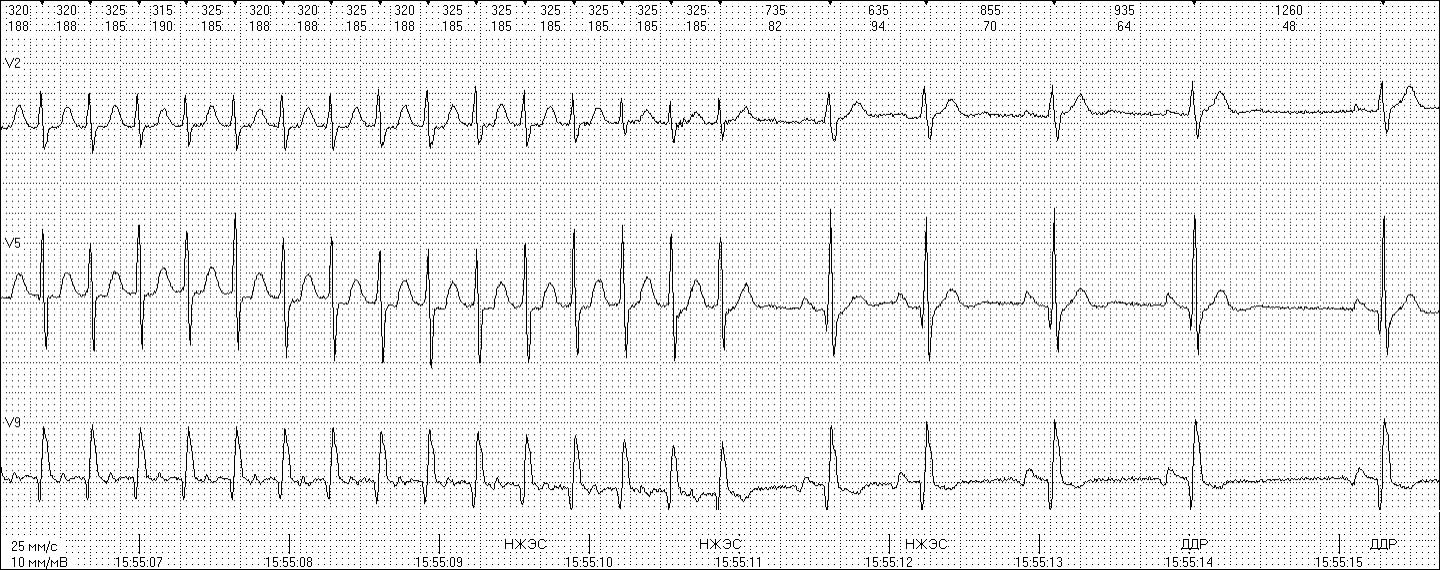 холтер, холтеровский мониторинг, холтеровский мониторинг ЭКГ, суточный мониторинг ЭКГ, длительный мониторинг ЭКГ, пароксизмальная наджелудочковая тахикардия