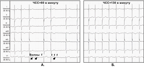 Фибрилляция предсердий. А. – нормосистолический вариант, Б. – тахисистолический вариант.