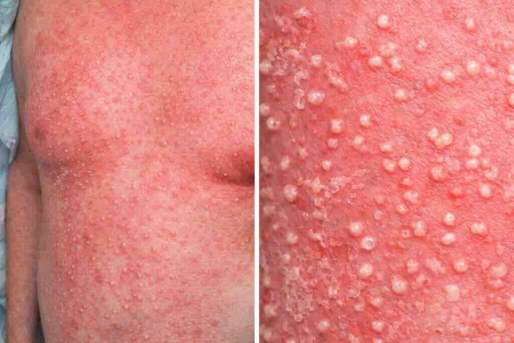 Двухпанельная иллюстрация AGEP: диффузная эритема кожи с множественными мелкими однотипными поверхностными неперифолликулярными пустулами; на крупном плане видны характерные “рассыпные” стерильные пустулы и начальное шелушение.