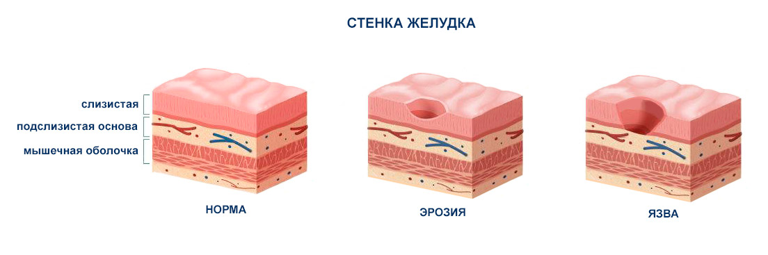 язва желудка, хеликобактер пилори