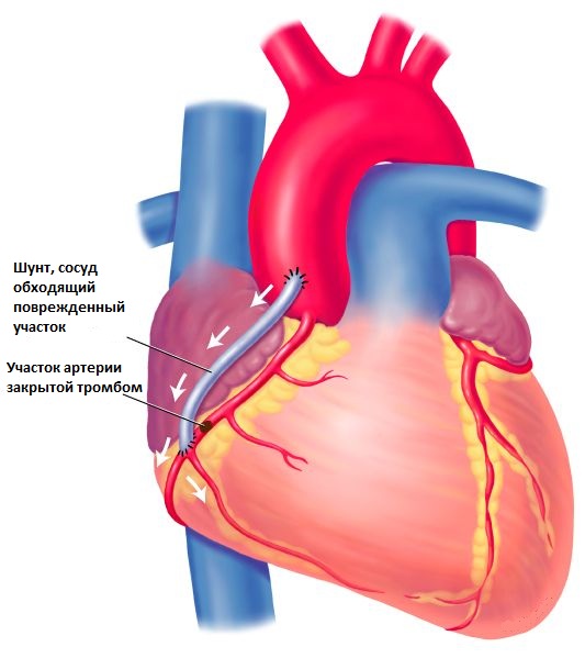 АКШ, аортокоронарное шунтирование