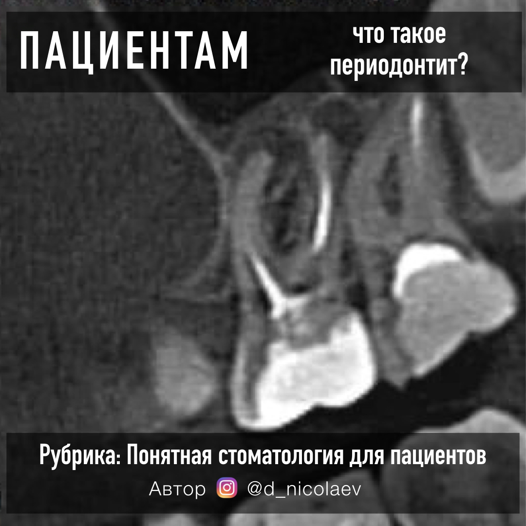 периодонтит периодонтит