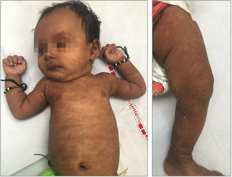 диффузная гиперпигментация, связанная с лихорадкой чикунгунья диффузная гиперпигментация, связанная с лихорадкой чикунгунья