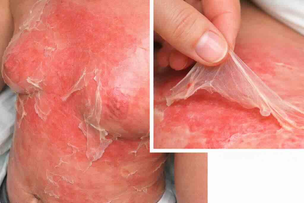 Двухпанельная иллюстрация стафилококкового синдрома ошпаренной кожи (SSSS/ССОК): диффузная эритема с пластинчатым поверхностным слущиванием; на крупном плане показано отслаивание тонкого слоя эпидермиса, характерное для поверхностного поражения.