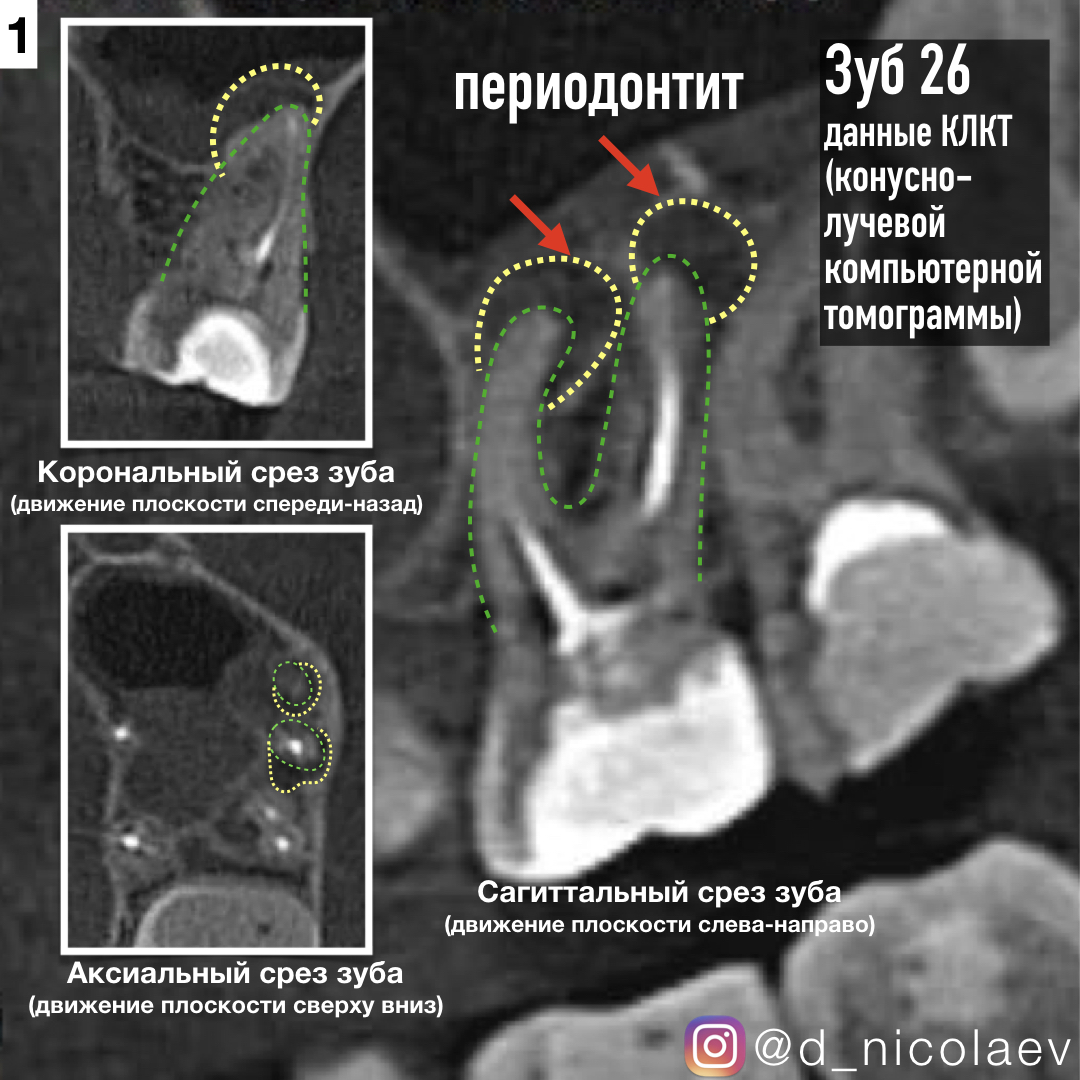 периодонтит периодонтит