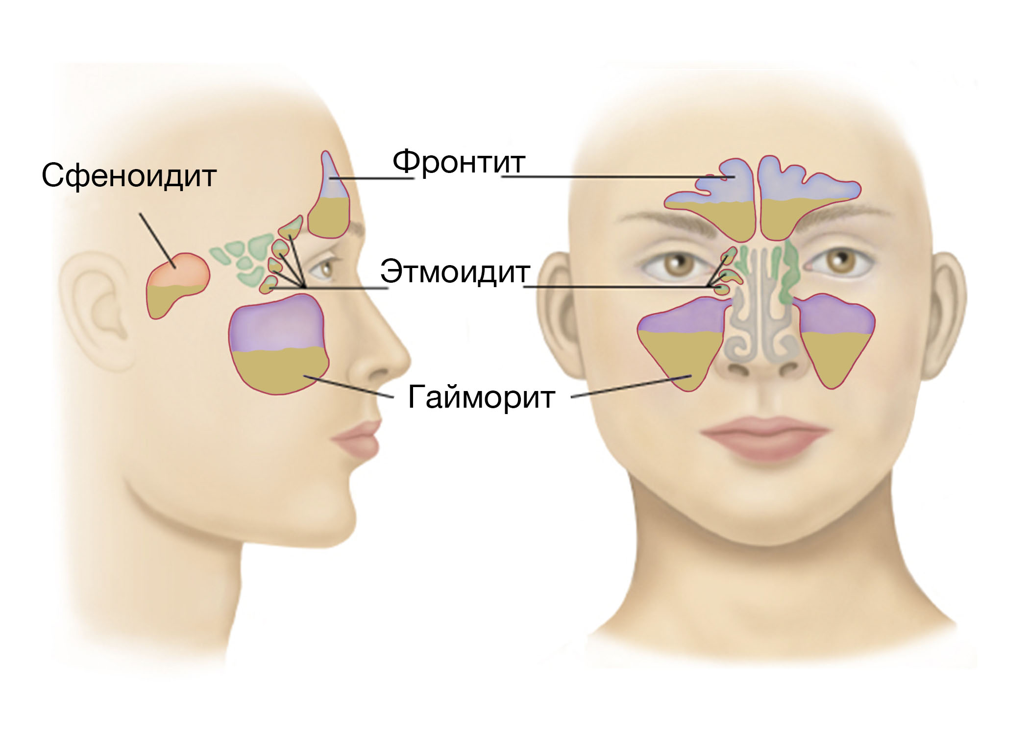 фронтит, этмоидит, сфеноидит, гайморит, синуситы