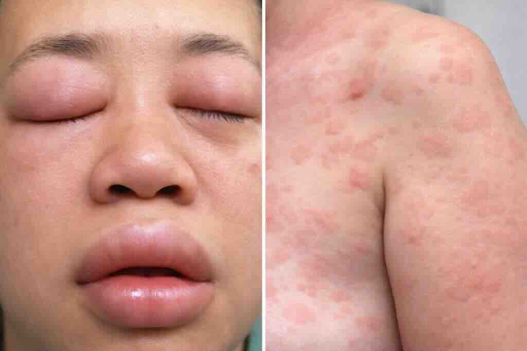 Пример типичных кожно-слизистых проявлений анафилаксии: ангиоотёк лица (губы/века) и уртикарная сыпь (крапивница) на коже.