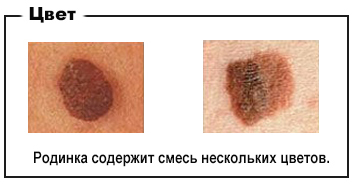 родинки, цвет родинки