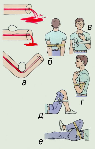 кровотечение, кровоостанавливающий жгут, наложение жгута при кровотечении, кровотечение