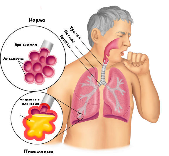 пневмония