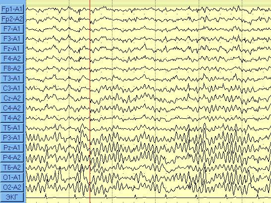 ЭЭГ, электроэнцефалограмма, электроэнцефалография, видео ЭЭГ мониторинг