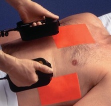 Медицинское изображение, иллюстрирующее процедуру электроимпульсной терапии (кардиоверсии) при нарушениях ритма сердца. Показано использование оборудования и восстановление нормального сердечного ритма.