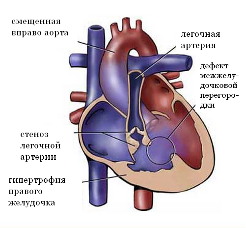 тетрада фалло тетрада фалло