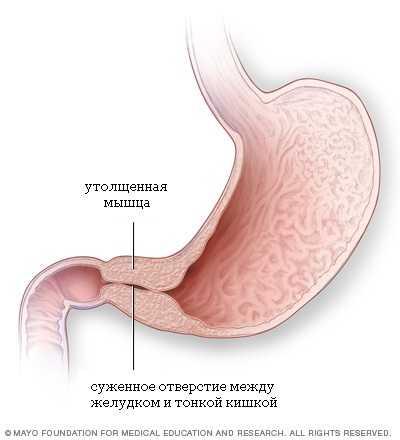 пищевод, желудок, печень, двенадцатиперстная кишка, тонкая кишка, толстая кишка, прямая кишка, пилоростеноз, пилоростеноз у детей фото пищевод, желудок, печень, двенадцатиперстная кишка, тонкая кишка, толстая кишка, прямая кишка, пилоростеноз, пилоростеноз у детей фото