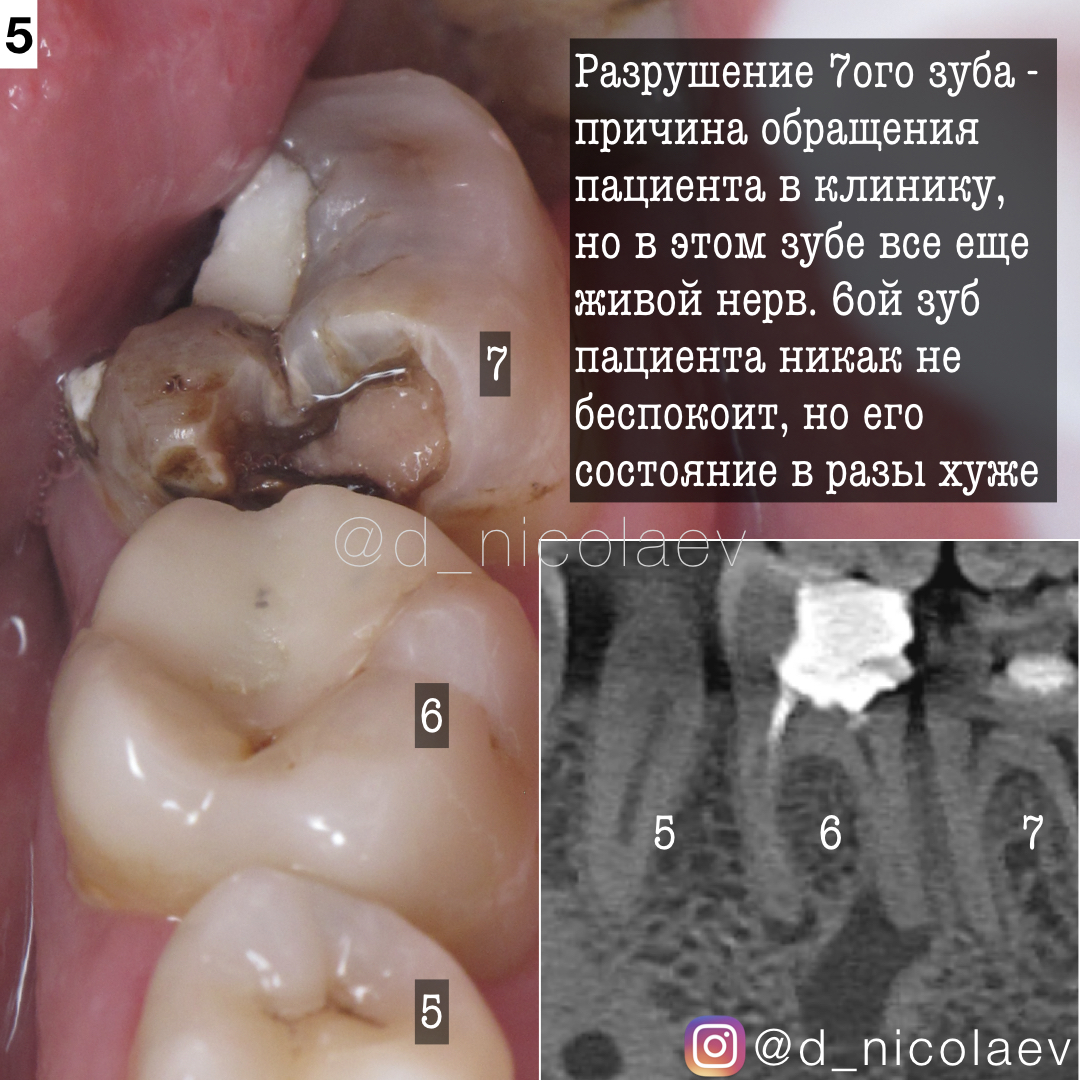 периодонтит