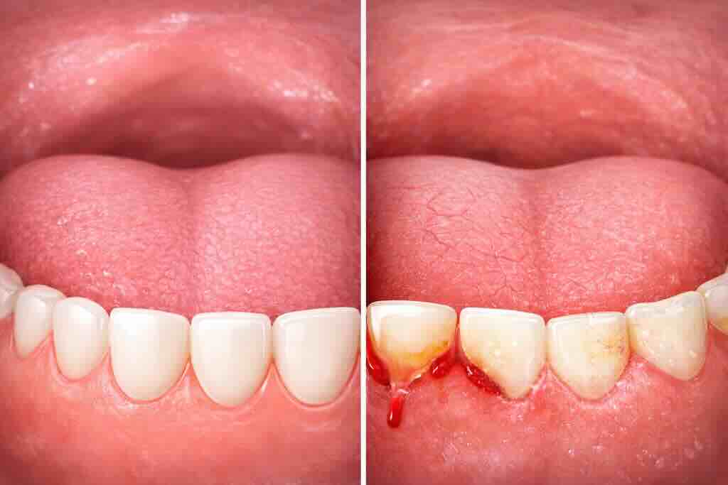 Слева — условно здоровая картина. Справа — пример того, как сухость во рту может сочетаться с налётом, раздражением дёсен и признаками повреждения эмали. Слева — условно здоровая картина. Справа — пример того, как сухость во рту может сочетаться с налётом, раздражением дёсен и признаками повреждения эмали.