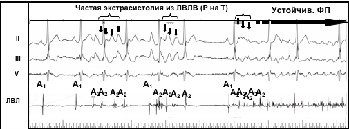 пароксизм фибрилляции предсердий