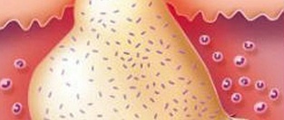 Абсцесс мягких тканей. Нужна ли системная антибиотикотерапия после вскрытия?