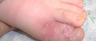 Герпетический панариций. Четвертый день болезни