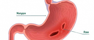 Язвенная болезнь желудка и двенадцатиперстной кишки