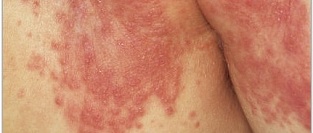 Пеленочный дерматит