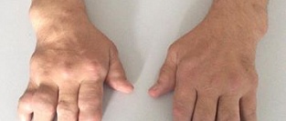 Подагра. Зависимость частоты приступов от времени суток