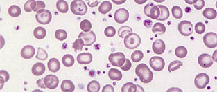 Изолированный тромбоцитоз как ранний признак злокачественных новообразований