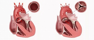 Лечение взрослых пациентов с врожденными пороками сердца. Позиция AHA