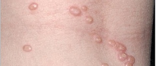 Контагиозный моллюск. Описание элементов сыпи.