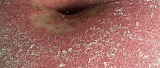 Псориаз и риск депрессии