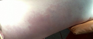 Некротизирующий фасциит. Внешние проявления